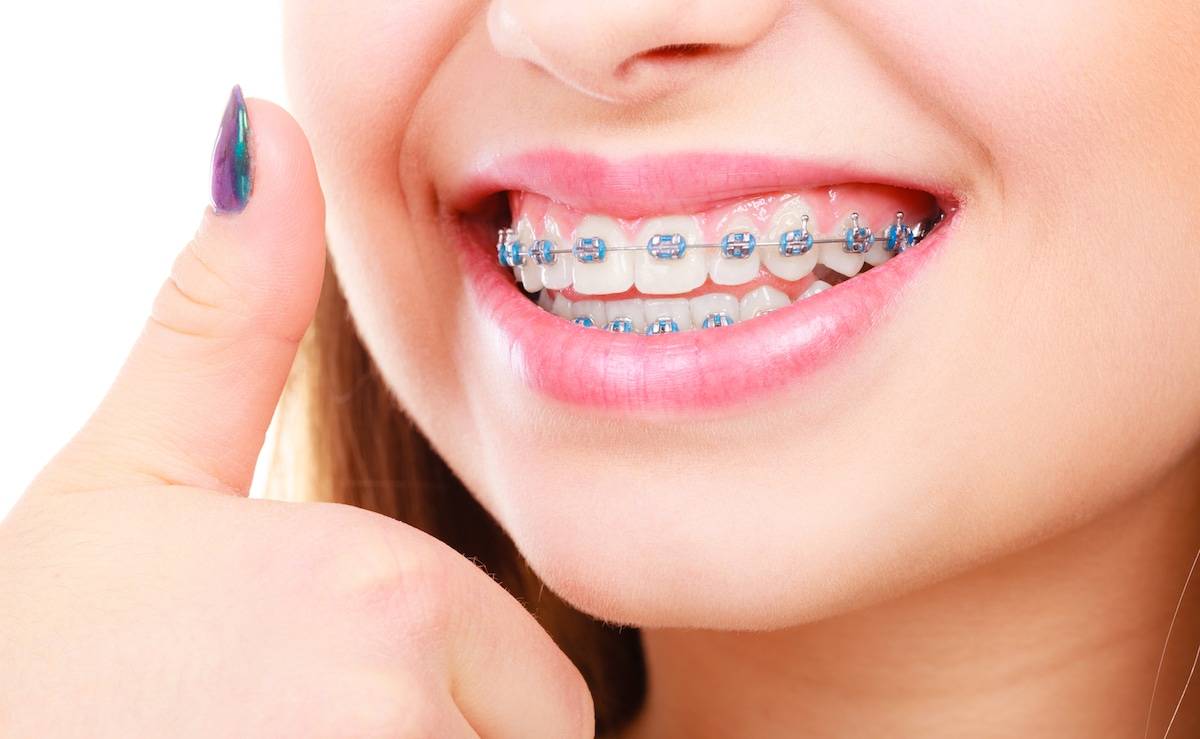 Get Ready: The Definitive Guide to Braces in London, ON